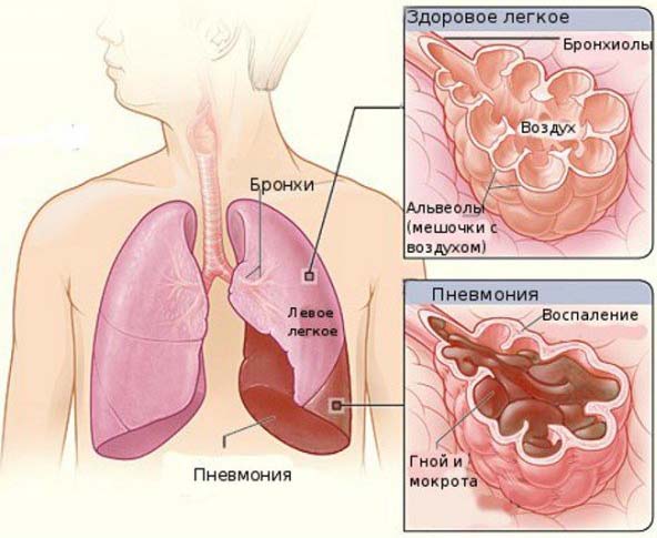 Воспаление легких