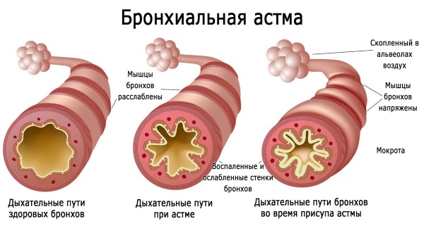 Жидкость в легких. Причины, почему скапливается, как откачивают, лечение и последствия